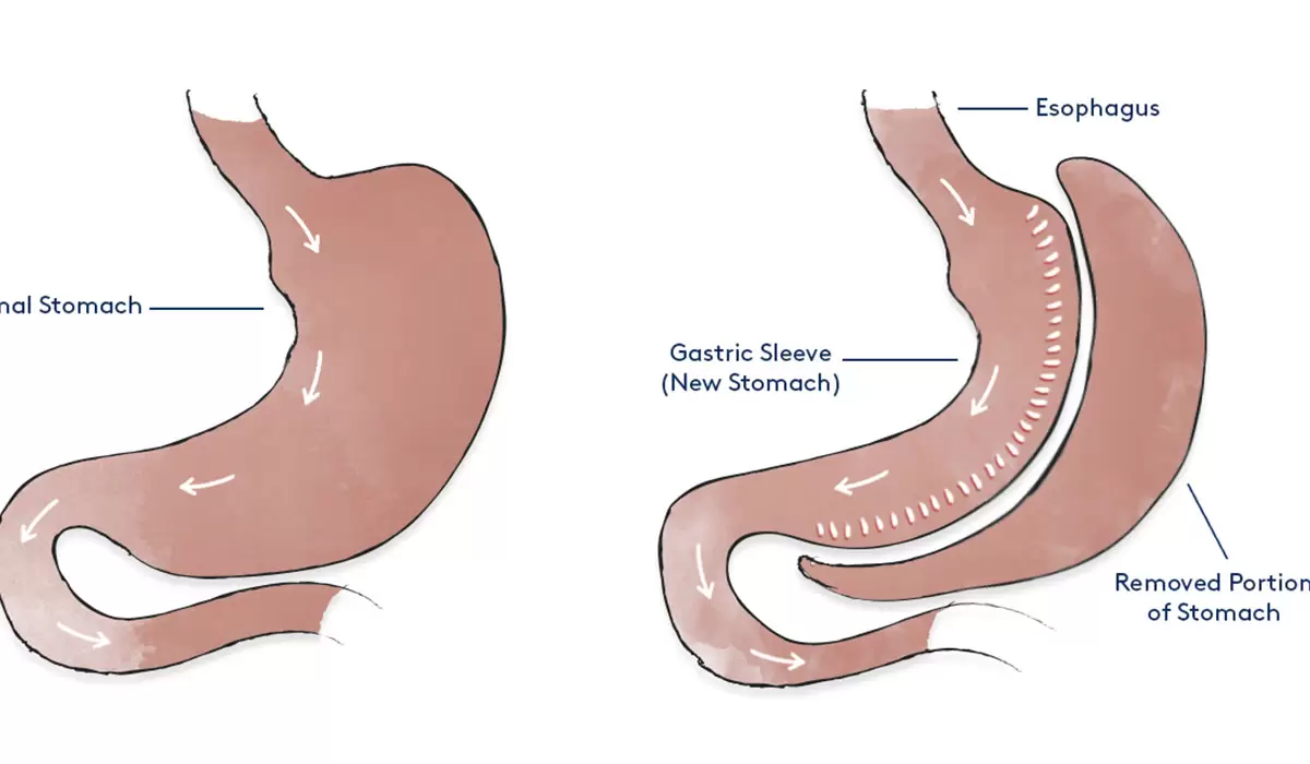 9 Todesursachen nach einer Sleeve Gastrektomie: