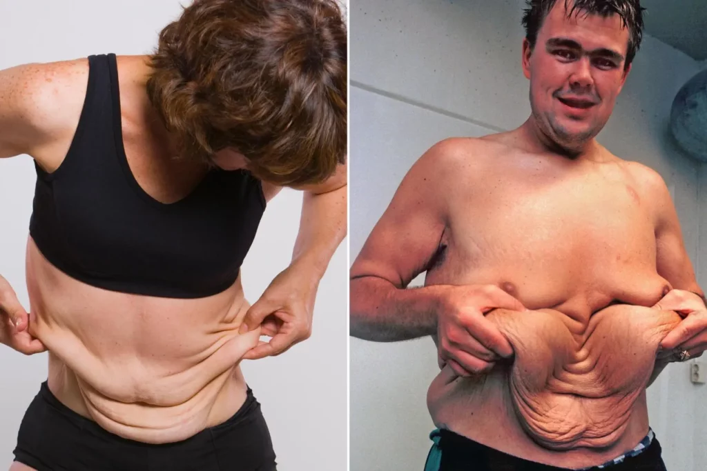 Hängende Haut nach Adipositaschirurgie: 7 Gründe